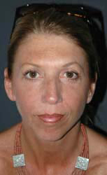 Eye Lift - Patient 1 - After